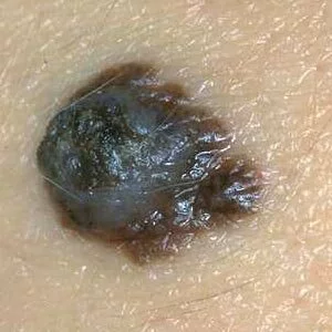 рак кожи начальная стадия фото